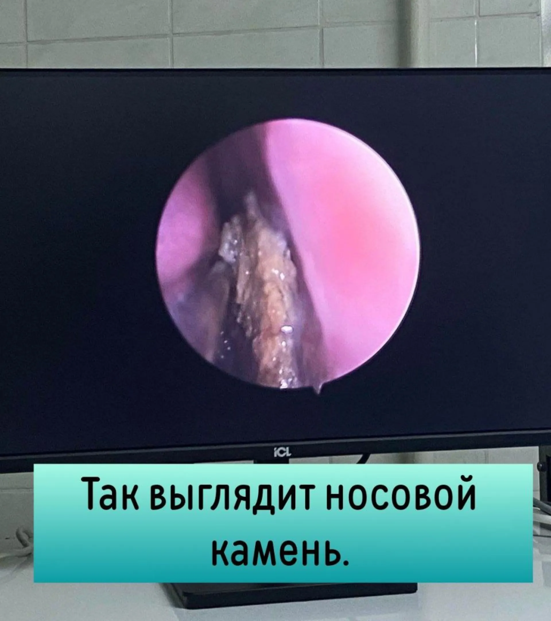 Огромный камень вырос в носу россиянки