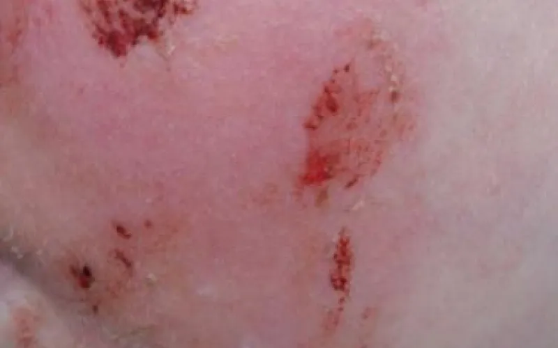 Школьнице в Барнауле плеснули в лицо кислотой: СК начал проверку